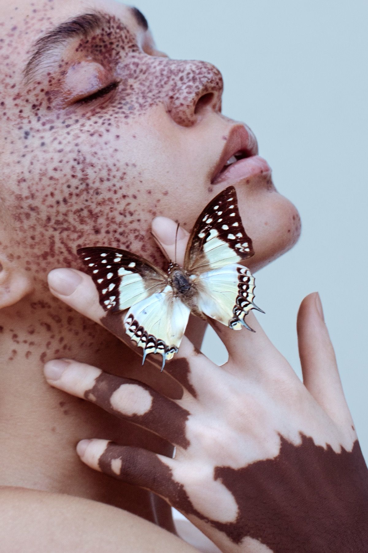 Beauty editorial, freckle art with butterfly and vitiligo